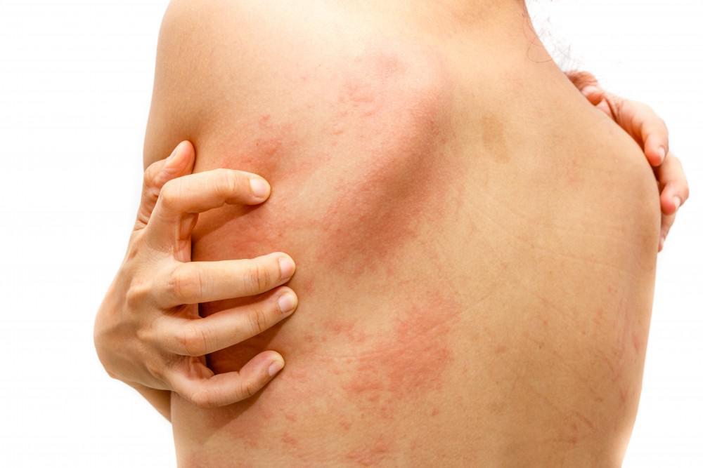 Allergic reaction heat rash  What causes it and how is it treated